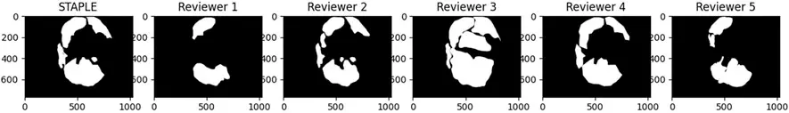 An image demonstrating inter-annotator variability, showing six medical image segmentations. Five masks show different annotations from five reviewers, highlighting inconsistencies, while a sixth 'STAPLE' image shows the computed consensus or ground truth.
