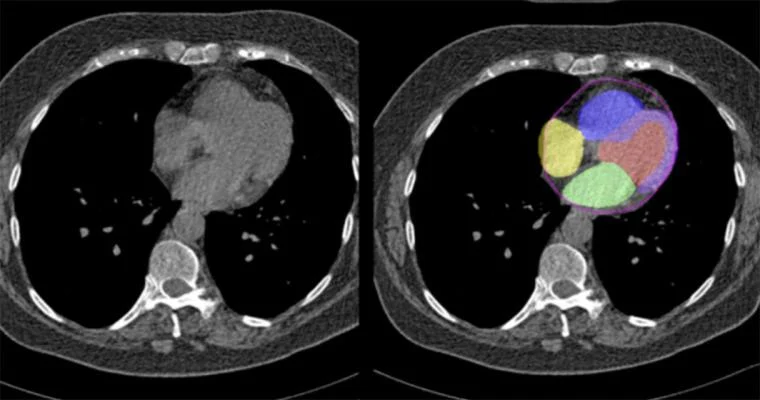 CT scan of a chest, with AI-powered image segmentation highlighting the different chambers of the heart in various colors