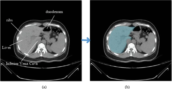 Before-and-after abdominal CT scans showing an AI model performing image segmentation to accurately highlight the liver