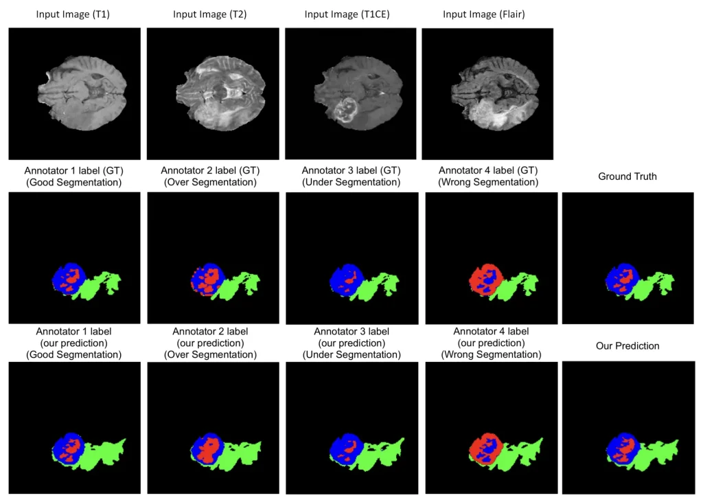 Comparison of MRI brain tumor segmentation by four different annotators, showing the impact of label quality on AI model ground truth