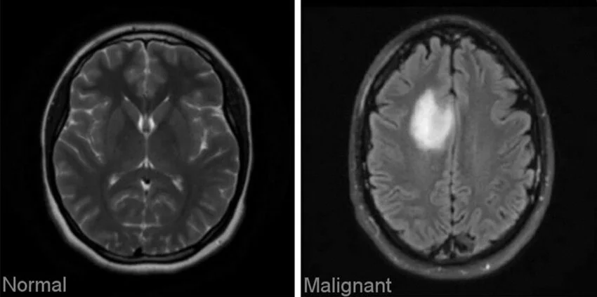 Comparison of a normal brain MRI and one with a malignant tumor, illustrating AI's use in detecting abnormalities